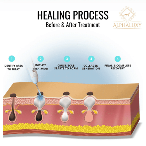 alphaluxy™ plasma pen – official retailer