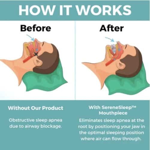 SereneSleep™ Snoring Prevention Aid - Official Retailer